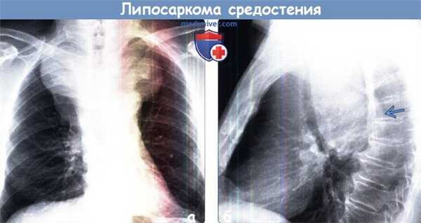 Липосаркома средостения на рентгенограмме