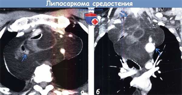 Липосаркома средостения на КТ
