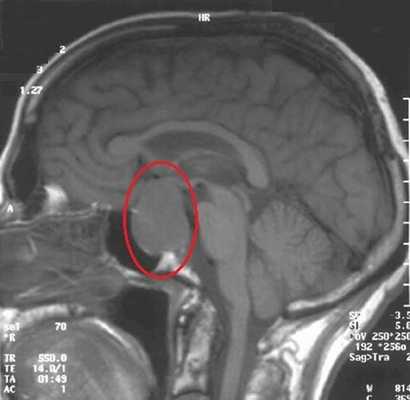 МРТ гипофиза