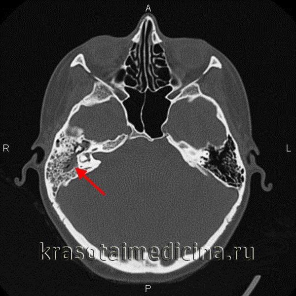 Мезотимпанит