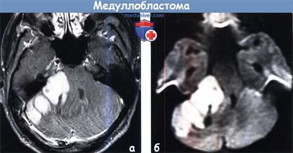 Медуллобластома на МРТ