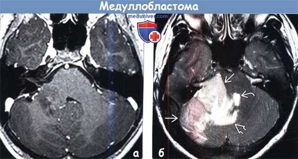 Медуллобластома на МРТ