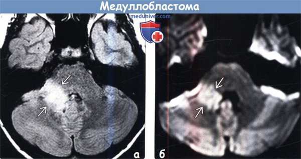 Медуллобластома на МРТ