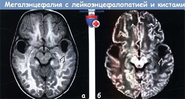 Мегалэнцефалия с лейкоэнцефалопатией и кистами на МРТ