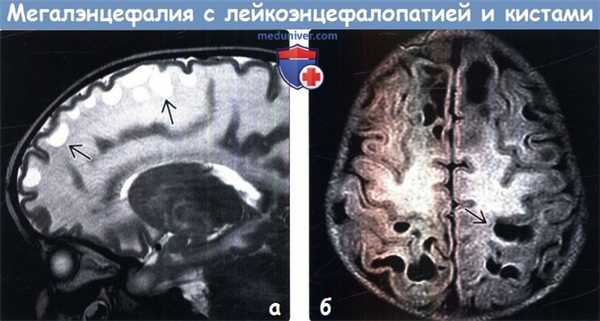 Мегалэнцефалия с лейкоэнцефалопатией и кистами на МРТ