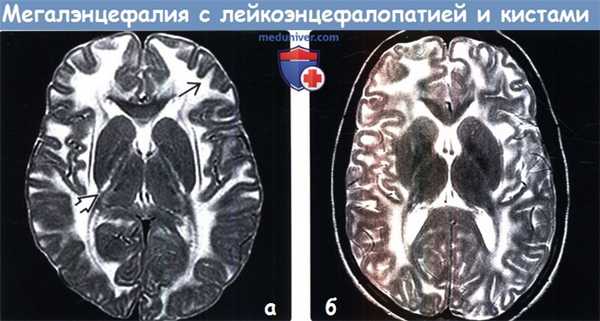 Мегалэнцефалия с лейкоэнцефалопатией и кистами на МРТ