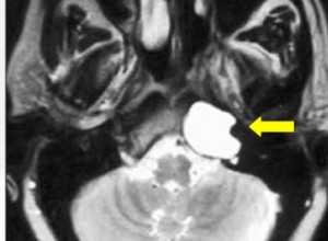 холестеатома