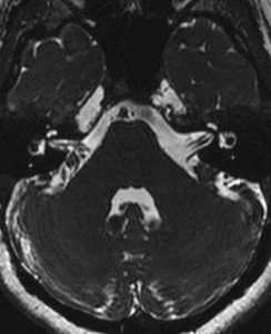 МРТ мостомосжечковый угла