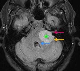 Шваннома с контр