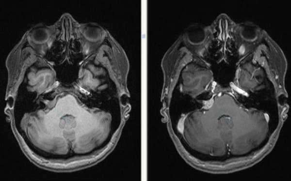 Невринома ММУ на снимках МРТ