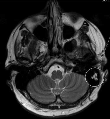 На мрт в аксиальной плоскости отмечается объемное образование внутреннего слухового прохода слева
