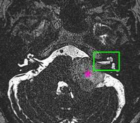 Шваннома с внутриканальцевой частью
