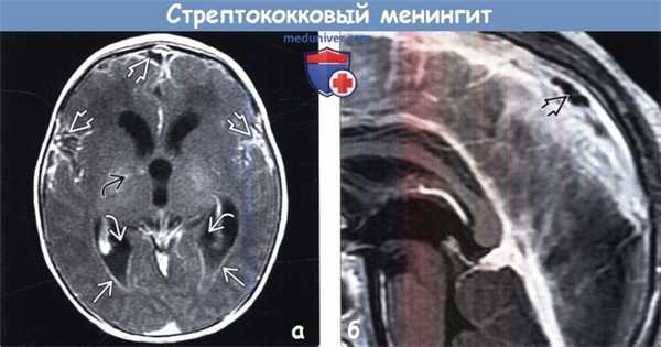 Стрептококковый менингит на МРТ