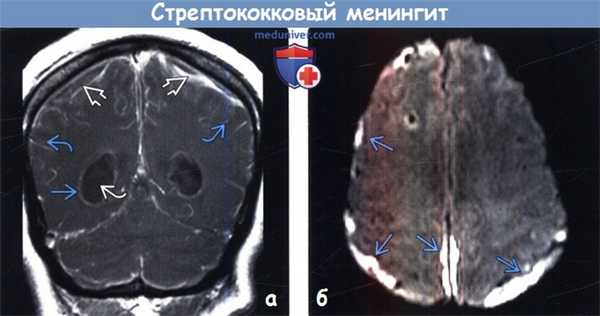 Стрептококковый менингит на МРТ