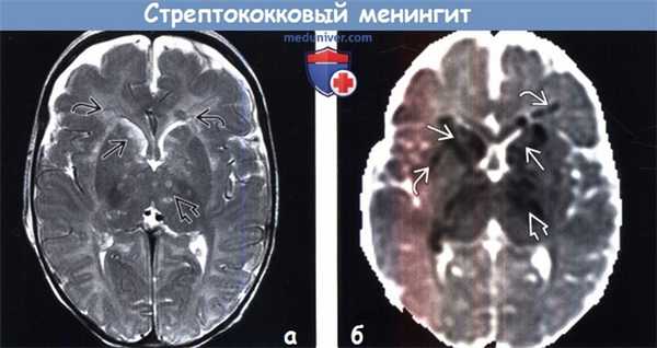 Стрептококковый менингит на МРТ
