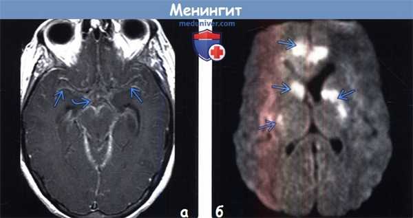 Менингит на МРТ