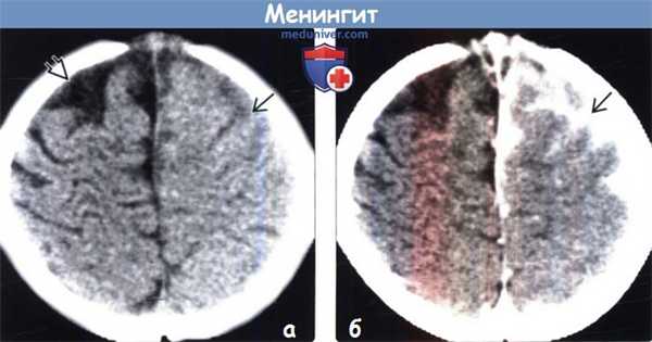 Менингит на КТ, МРТ