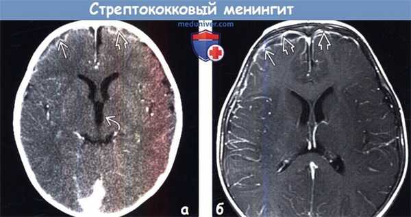Стрептококковый менингит на КТ, МРТ