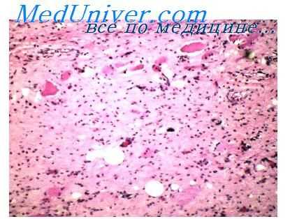 ангиомиксома