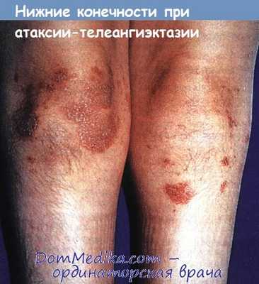 атаксия-телеангиэктазия