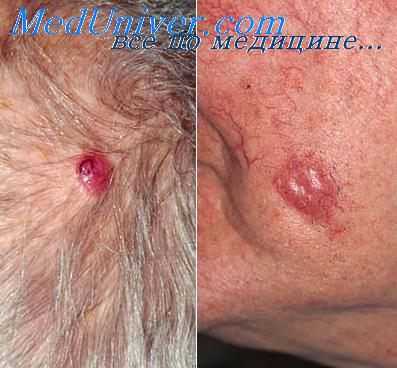 меркелиома на голове больного