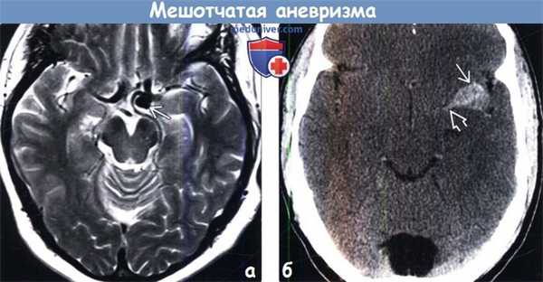 Мешотчатая аневризма на КТ, МРТ