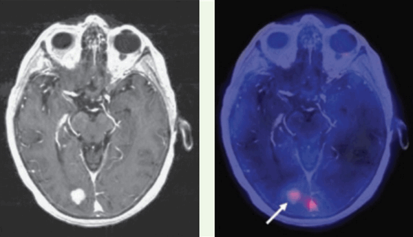метастазы в мозг ПЭТ