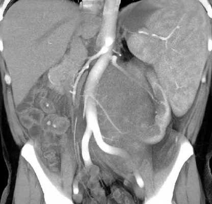 Рис. 6. МРТ нейрогенного образования забрюшинного пространства слева