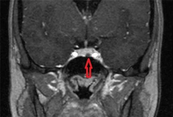 МРТ гипофиза с контрастом