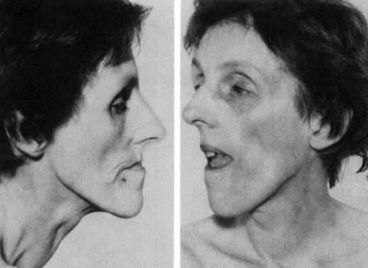 миотоническая дистрофия