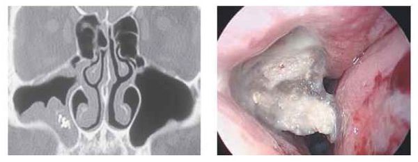 Мицетома гайморовой пазухи [16]