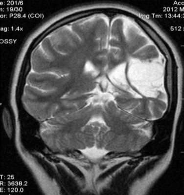 Левосторонняя инволюция ткани головного мозга
