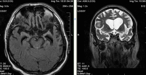 Атрофия лобных и височных долей на МР-сканах