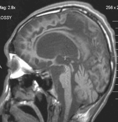 Процедура ПЭТ-КТ головного мозга