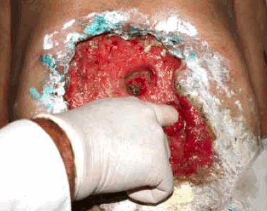 Кишечный свищ