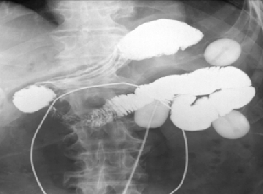 Кишечный свищ