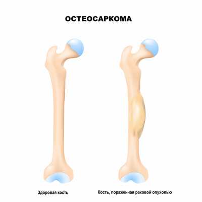 Остеосаркома.jpg