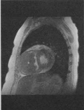 Снимки МРТ и КТ. Недифференцированная саркома