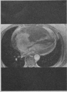 Снимки МРТ и КТ. Недифференцированная саркома
