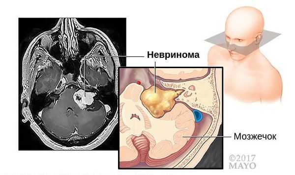 МРТ невриномы слухового нерва