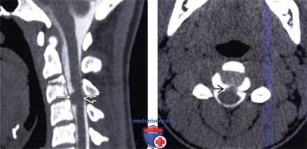 КТ при нейроэнтеральной кисте