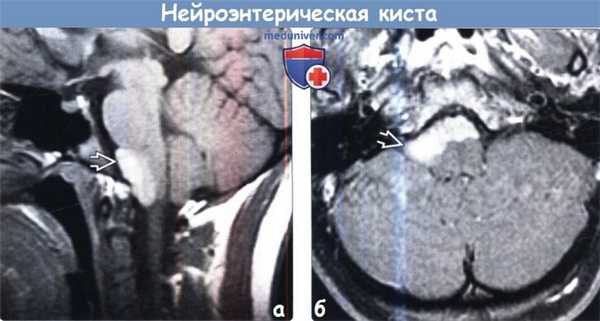 Нейроэнтерическая киста головного мозга на МРТ