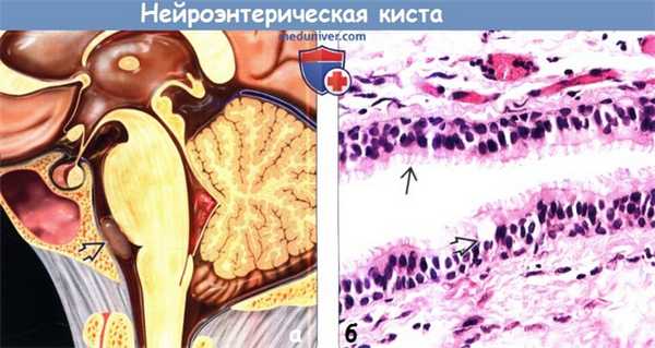 Нейроэнтерическая киста - гистология, морфология