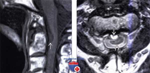 МРТ при нейроэнтеральной кисте