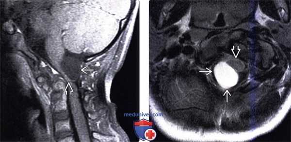 МРТ, КТ при нейроэнтеральной кисте