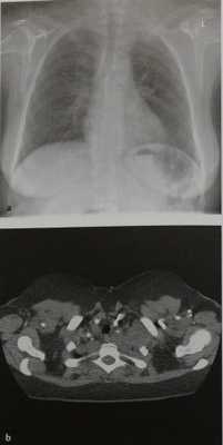 Снимки МРТ и КТ. Нейрогенные опухоли