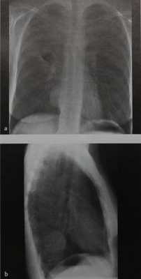 Снимки МРТ и КТ. Нейрогенные опухоли