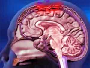 поражение мозга