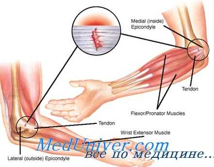 эпикондилит плеча