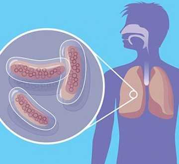 Фото Инфильтративный туберкулез: что это такое?